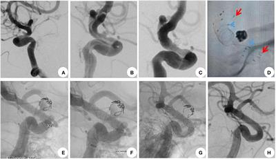 Retreatment with a flow diverter for recurrent blood blister-like aneurysms after embolization: A single-center case series